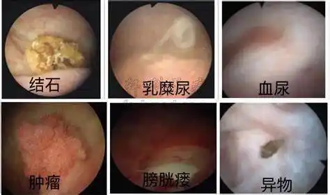 膀胱镜检查,到底有啥用?(附视频)_膀胱癌_介绍_检查 - 好大夫在线