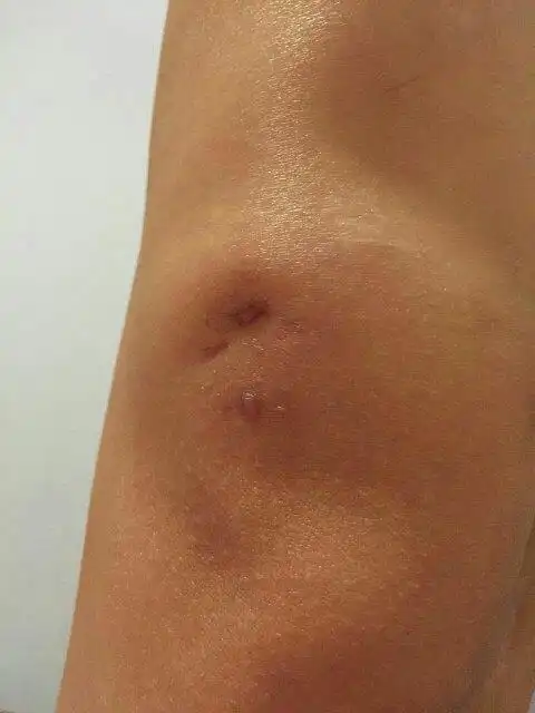 为什么这两个刀口一个往里凹一个有鼓包,外缝,半月板手术,术后两个月