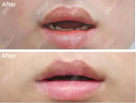 看北京八大处宋涛唇隐裂实例,了解口碑和修复技术怎么样