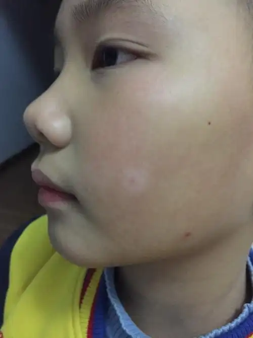 杨教授你好孩子今年十岁脸上有块白斑一直大意以为是汗斑