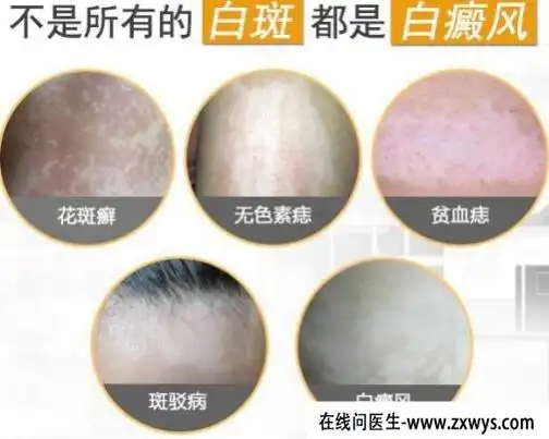 胳膊上长白斑图片,要警惕4种情况(白癜风可能会痒)