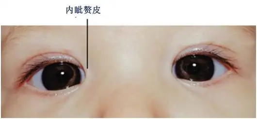 内斜视不会随着年龄增长而消失,而内眦赘皮导致的"斗鸡眼"会,家长们要
