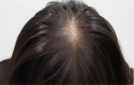 植发手术技术为了改变头发稀少的问题,女性朋友可谓是绞尽了脑汁,甚至
