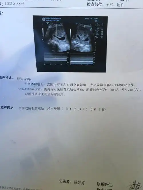 两个孕囊,两个胎盘的双胞胎