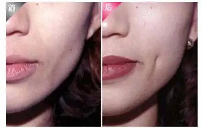 人造酒窝,医学上称为酒窝成形术,是指在面部的特定部位,用手术的方式