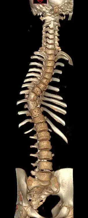 精准解除斑点男孩的心腹之患我院成功实施一例机器人辅助重度脊柱侧弯