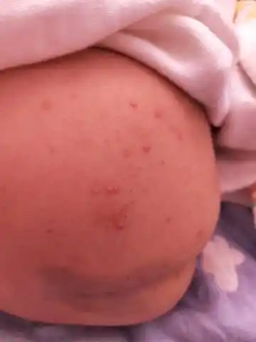 宝宝屁股上起的什么疙瘩