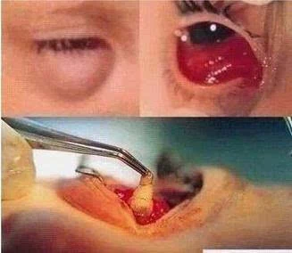 11岁男孩眼睛长蛔虫 少儿险应分阶段购买