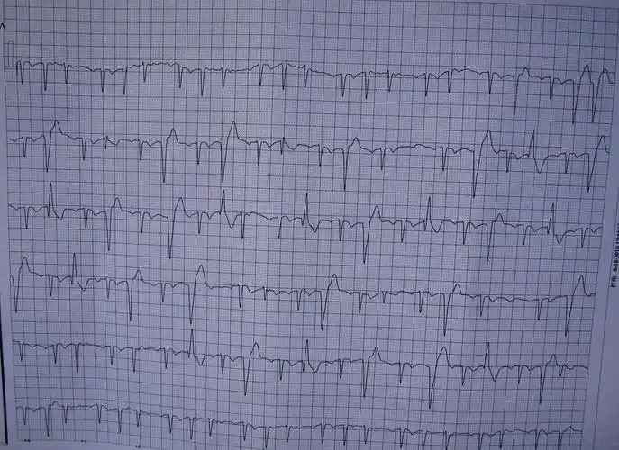 一个病人三次复查的心电图