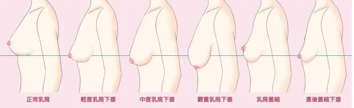 关于乳房下垂,相信很多女性朋友都.@靳君医生的动态