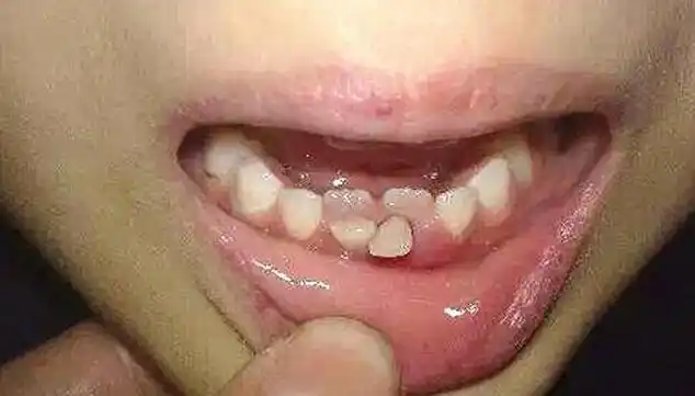 越来越多孩子长"双排牙",与糖果无关,是父母喂养有误区|乳牙|恒牙
