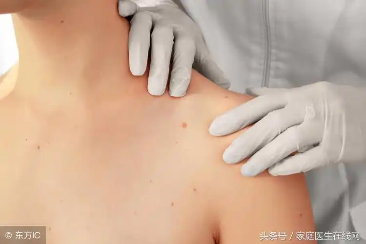 黑色素瘤早期症状图片(身上的痣有这6个变化) - 赤虎壹号