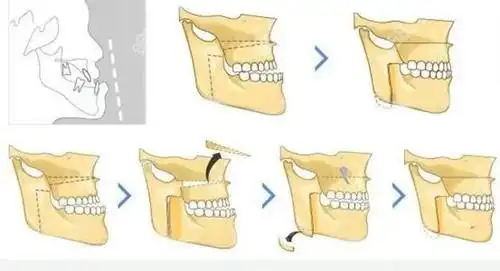 骨性地包天矫正手术风险大吗从地包天做正颌手术过程了解