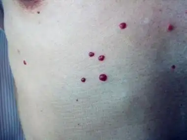 身上为什么会长出一些小红痣?对健康有影响吗?专家给出解释