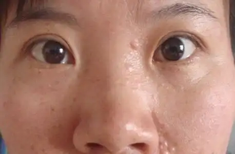汗管瘤图片眼部图片 (4)