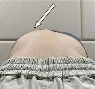 简单辨别脊柱侧弯避免孩子走弯路