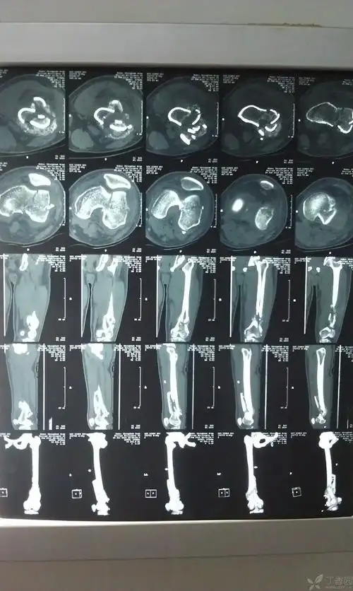 股骨髁骨折 - 骨科专业讨论版 -丁香园论坛