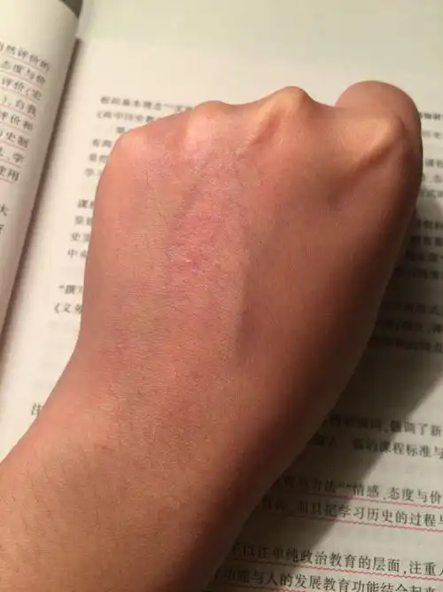 麻烦给看下手背上的皮肤是不是有问题?