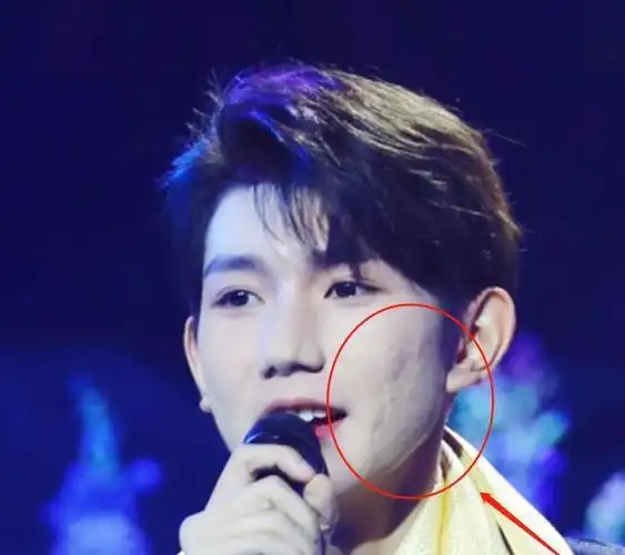 从画面上能够很清楚看到,王源的脸上还是有很明显的痘印,王源的这个