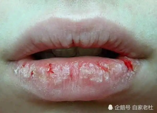 嘴唇干裂涂口红很丑教你3个缓解嘴唇干裂妙招总有一个适合你
