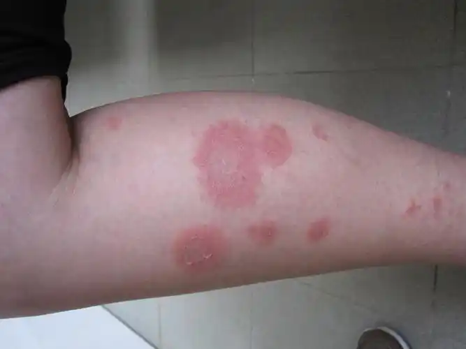 米粒大丘疹长成大红斑-多形红斑型药疹 - 皮肤及性传播疾病讨论版