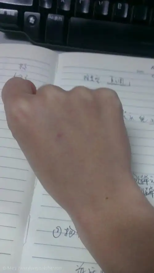 知道打针会有创伤 以为只是个针眼