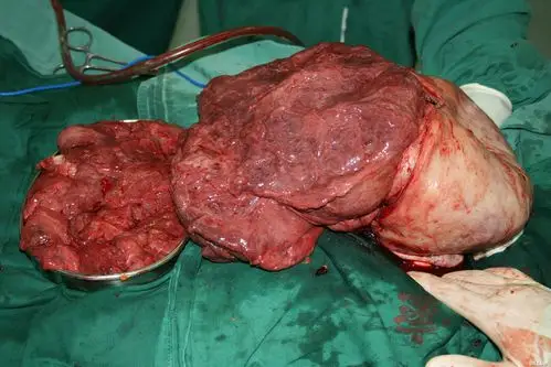 【图片】巨大子宫肌瘤伴红色变性