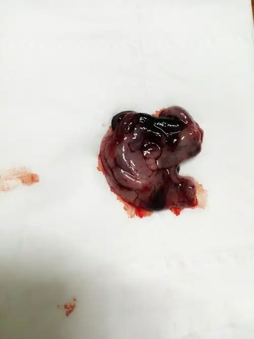 三天后傍晚肚子闷闷的疼,排出一块脚趾头般大的组织,是胚胎组织吗?