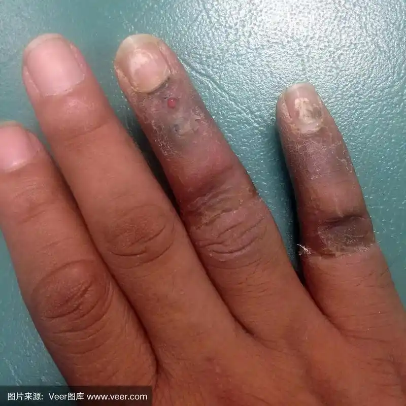 手指感染性伤口