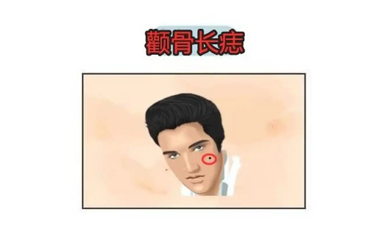 颧骨长痣  颧骨代表的是一个人权力的象征,若是一个人的颧骨上长痣,这
