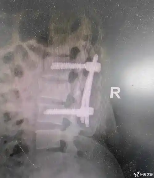 一例椎弓根螺钉尾帽游离病例