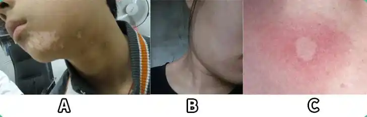 误判后果很严重!_汗斑_皮肤_呈圆形