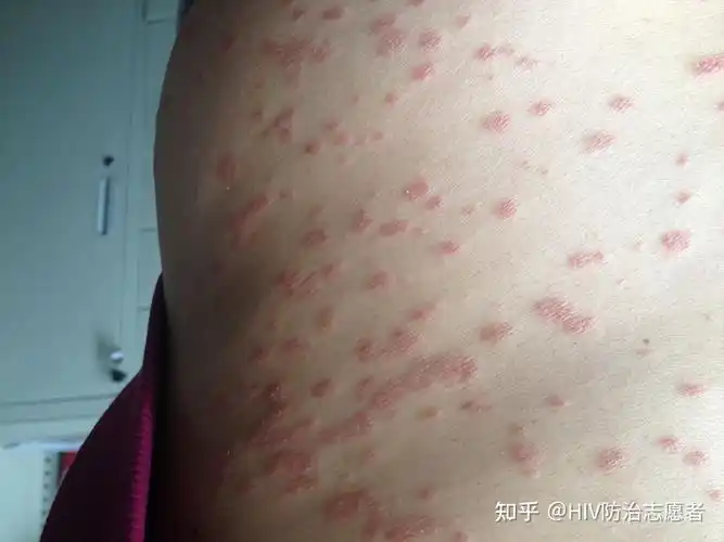 因为皮肤的疾病也是可以起皮疹的,并且皮疹并不是艾滋病的专项症状