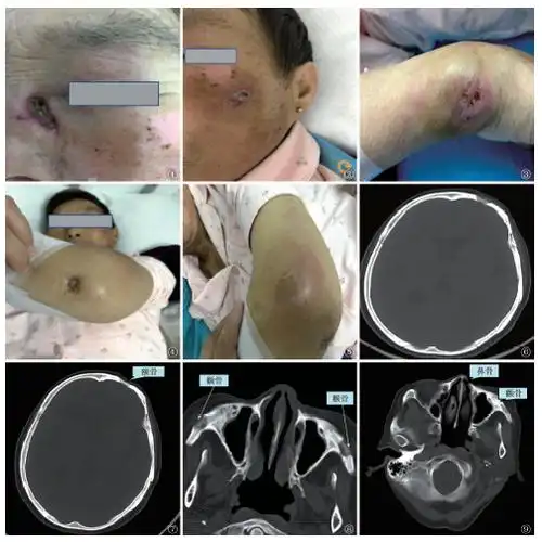一例多发性骨关节结核并发皮肤结核患者的诊治过程分析