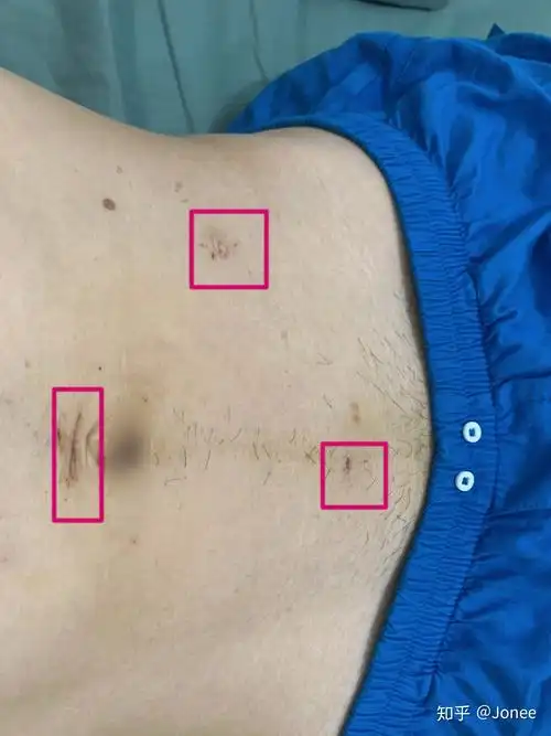 阑尾炎手术是什么体验? - 知乎