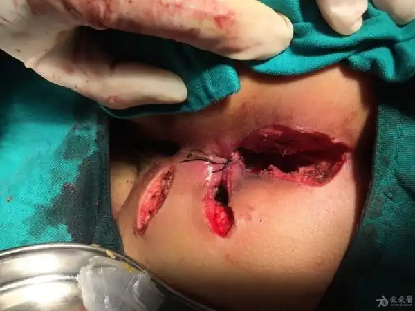 千奇百怪的肛周脓肿和肛瘘切口,大家都来评论!