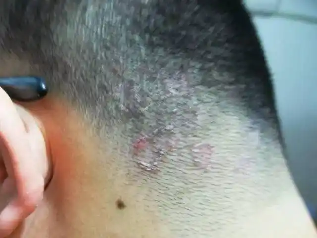 湖北男子后脑勺上长出50条蛆虫!竟是因为他的一个平常动作.