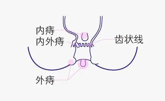 痔疮_肛肠专科_诊疗项目_重庆大渡口仁同肛肠医院【官方网站】