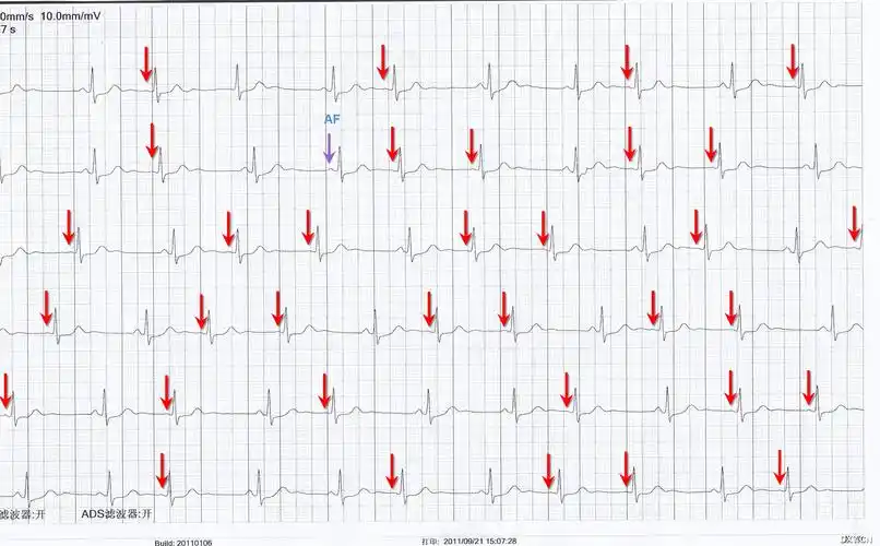 多变的p波 - 心血管专业讨论版 -丁香园论坛