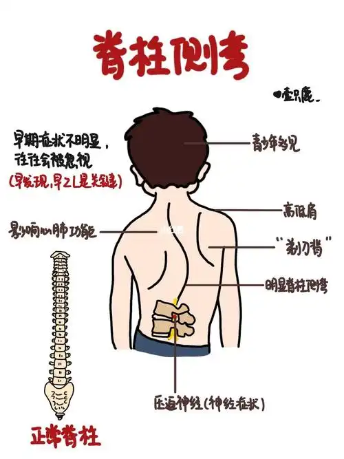 医学生笔记脊柱侧弯6971