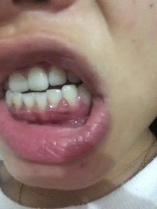 怀孕牙龈肿痛怎么办