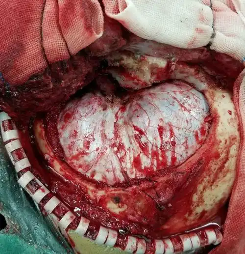 osirix辅助下额颞开颅切除左侧大蝶岩脑膜瘤 - 好大夫在线