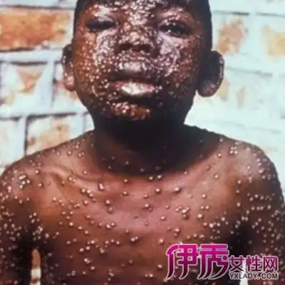 【图】有关天花病毒感染者照片 和你盘解天花病毒的传播历史