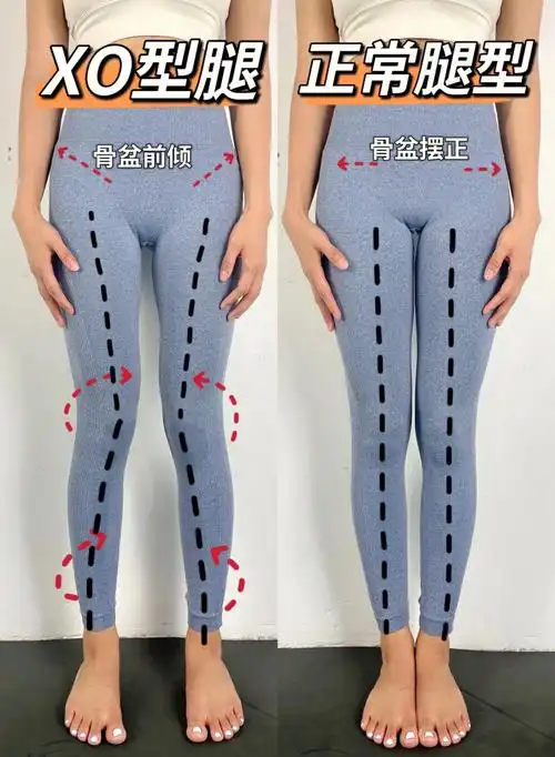 xo型腿矫正75七天改善方案必收藏版73