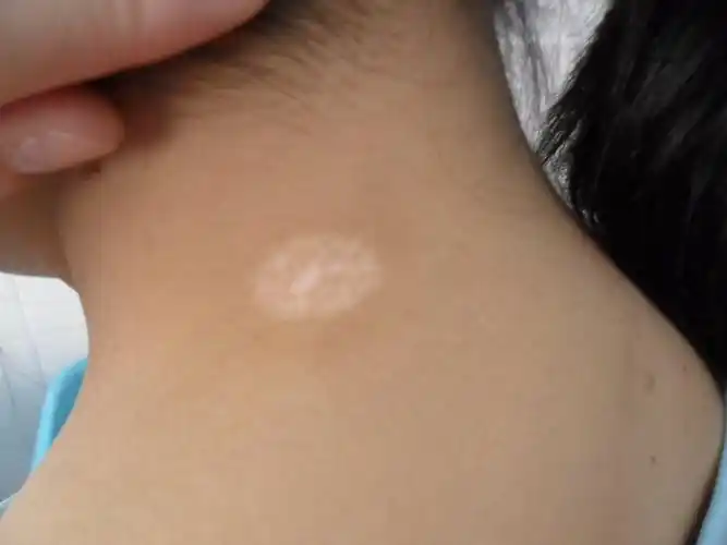 的面积大小有所不同,表面比较光滑;初期的时候通常表现为色素减退斑