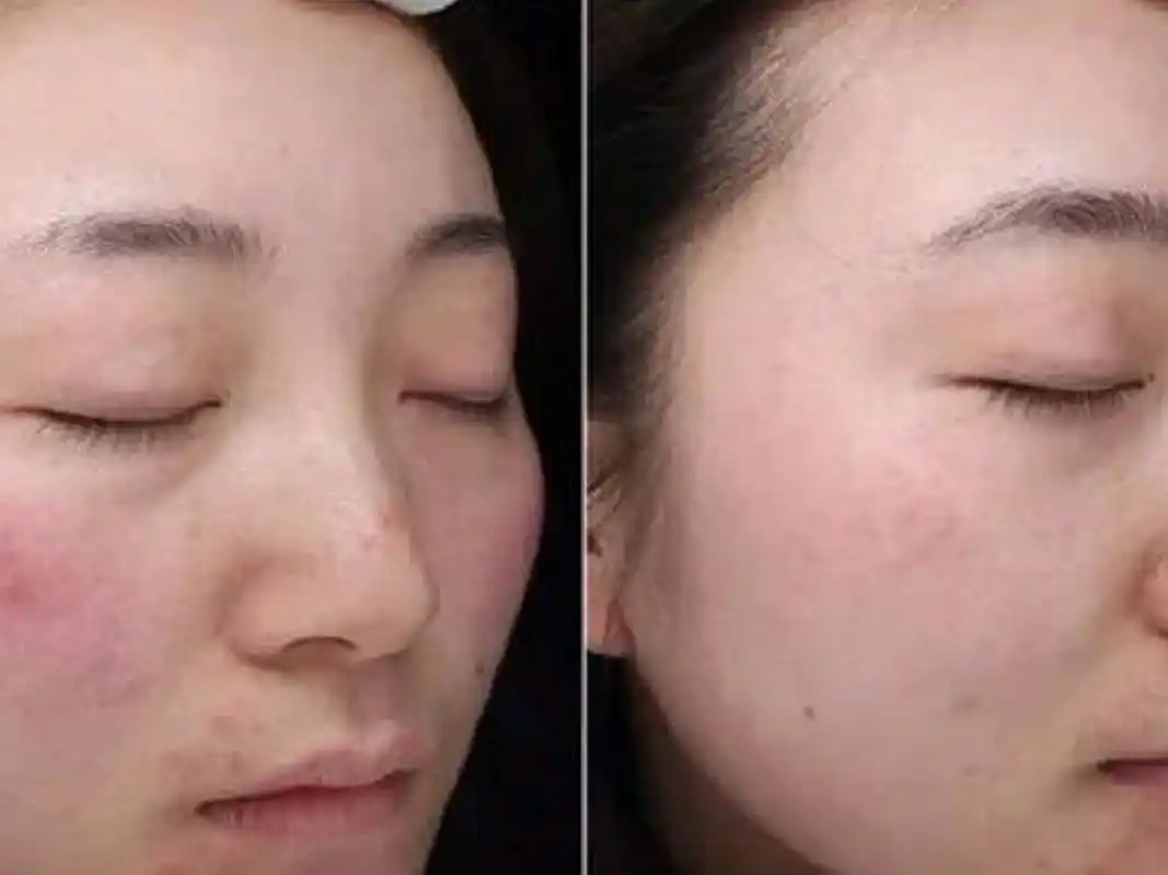 果酸换肤效果图,4大优点,令你焕然一新!(果酸美肤,换肤效果图)-52线报