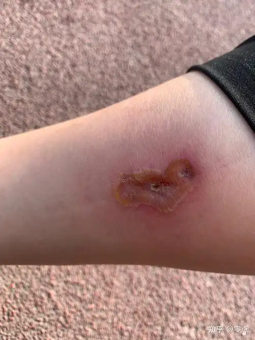 艾灸烫伤低温烫伤记录