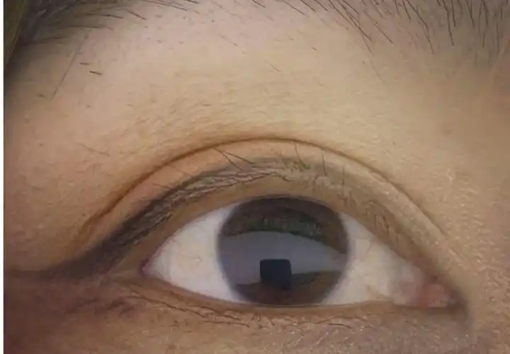 散瞳后是什么感觉