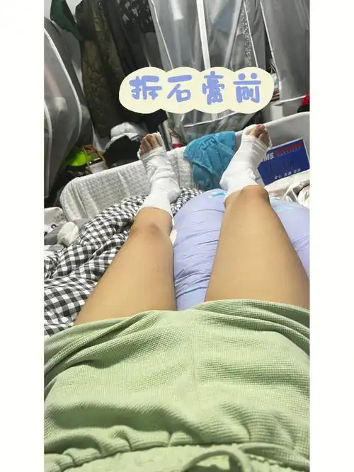 副舟骨切除术后第24天记录