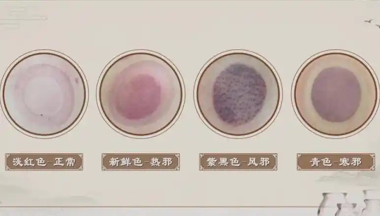 拔罐真的能治病?拔出来黑,紫,青,红各色的罐印都说明什么?